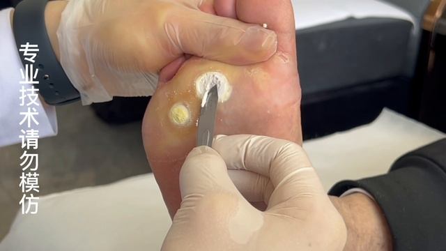 The Uncle Came To The Store To See The Plantar Wart, And It Was So Big!