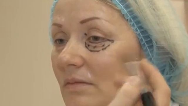 Блефоропластика 1 смотреть онлайн