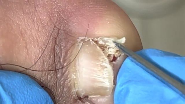 A close-up look at a pedicure: a step-by-step pruning process【Xue Yidao Pedicure】 смотреть онлайн