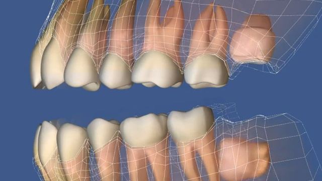 Хирургия  Ретенция, горизонтальное положение нижнего зуба мудрости, смещение зубного ряда