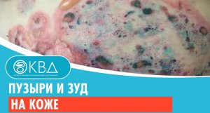 ? Пузыри и зуд на коже. Клинический случай №956