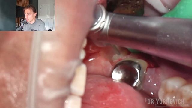 Как удалить непрорезавшийся нижний зуб мудрости? Подробный видео разбор по кейсу с полной ретенцией смотреть онлайн