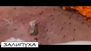 ПРЫЩИ ВЫДАВЛИВАНИЕ. ВЫДАВЛИВАНИЕ ОДНОГО БЕЛОГО ПРЫЩА. БЕЛЫЙ ЖИРНЫЙ ПРЫЩ. ПРЫЩИ ВЫДАВЛИВАНИЕ НОВОЕ