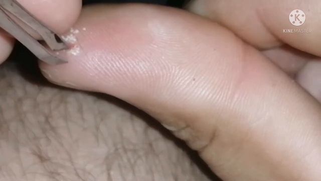 Как вынуть глубокую занозу