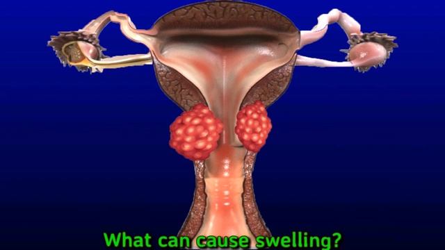 Swollen Supraclavicular Lymph Nodes: Causes And Treatment смотреть онлайн