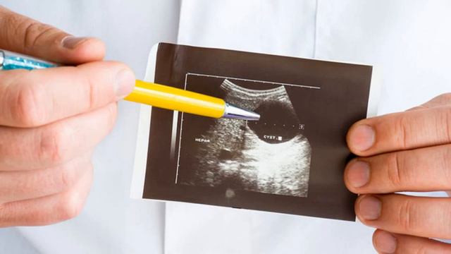 Savol Javob:JIGAR KISTASI Haqida