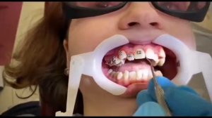 КАК УСТАНАВЛИВАЮТ БРЕКЕТЫ