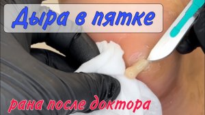 😱ГНОЙ в пятке _ работа СКАЛЬПЕЛЕМ🗡️ _ боль в пятке