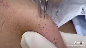 Черные точки и милиумы, большие кистозные угри Удаление черных точек Удаление белых точек