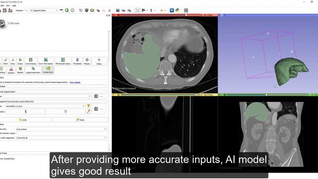 AI-assisted Segmentation Using Free Tools - 3D Slicer And Nvidia Clara
