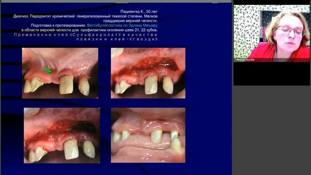 Клеевая композиция Сульфакрилат в стоматологической практике. смотреть онлайн