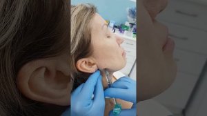 Корректируем угол нижней челюсти филлерами. Формируем красивый профиль лица.