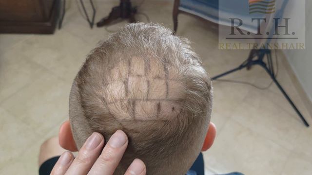 До и сразу после пересадки волос! смотреть онлайн