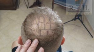 До и сразу после пересадки волос!