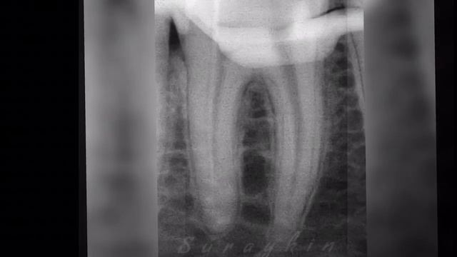 Извлечение фрагмента инструмента из корневого канала , извлечение отломка из канала зуба смотреть онлайн