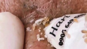 ✅ Выдавливание прыщей #10