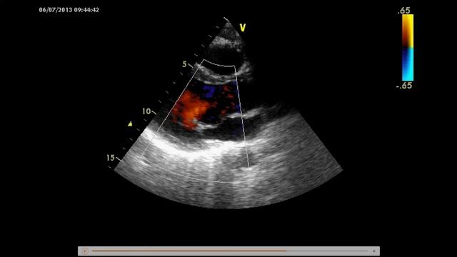4 ЭХОКГ.mp4 смотреть онлайн
