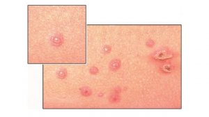 Ветрянка или ветряная оспа