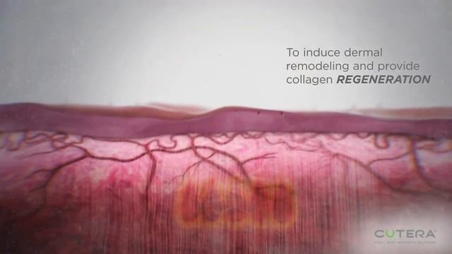 Secret RF - The Latest Acne Scar Treatment for Acne Scar Resurfacing смотреть онлайн
