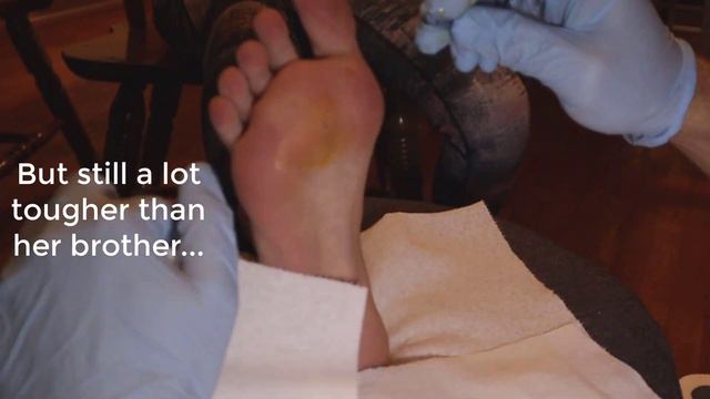 Plantar Wart Removal: How to Get Rid of a Foot Wart with No PAIN! смотреть онлайн