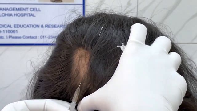 Alopecia areata - Injection technique for Triamcinolone acetonide @ 10 mg/mL (Dr Bhawuk Dhir) смотреть онлайн