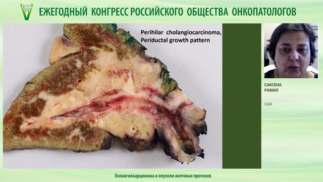 Холангиокарцинома и опухоли желчных протоков смотреть онлайн