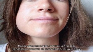 Опухшая щека после удаления зуба, что делать? Опухает ли щека после удаления зуба мудрости? Чем по.