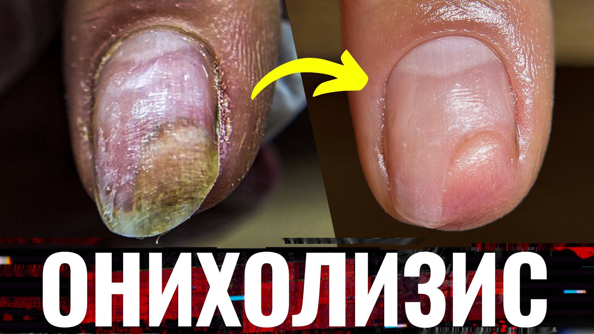 ⚡МНОГОЛЕТНИЙ ОНИХОЛИЗИС!😱 Зачистка онихолизиса ногтей на руках! смотреть онлайн