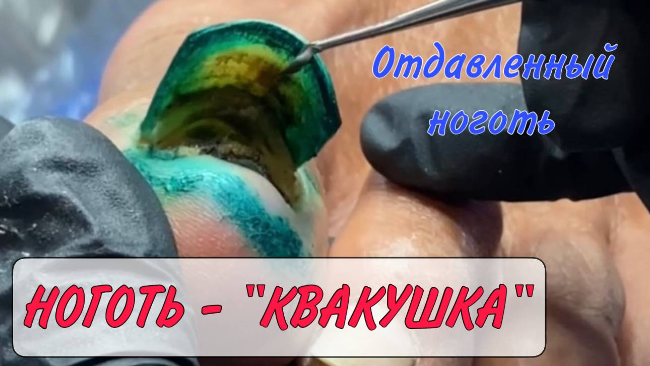 Отдавленный ноготь / отбитый ноготь / оторванный ноготь смотреть онлайн