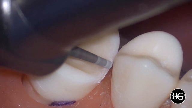 Final Steps Of Overlay Preps / Финальные этапы препарирования под накладку