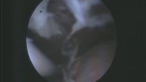 Мирена спираль. Мирена побочные эффекты.