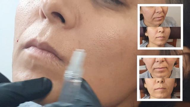 Бурун атрофи осилишини йукотиш Зумрад косметолог Санкт-Петербург 89045504503 смотреть онлайн