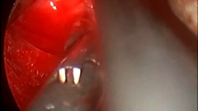 Mediastinoscopy смотреть онлайн