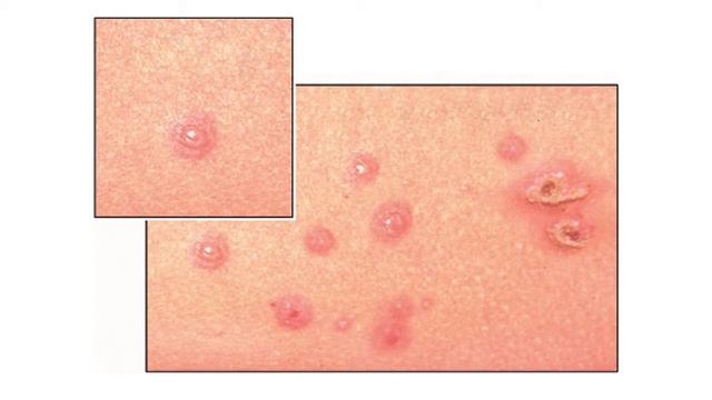 Причины заражения ветрянкой смотреть онлайн