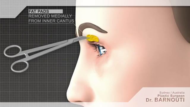 Cosmetic Surgery Animated Video | Eyelid Surgery