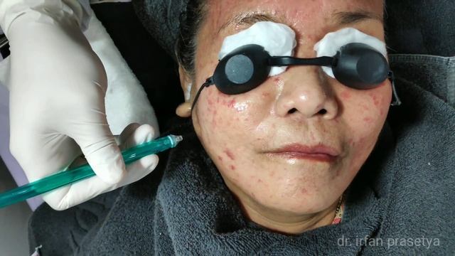 Jet-Peel | Jet-M | Jetpeeling With Oxygen | Natasha Skin Care Treatment смотреть онлайн