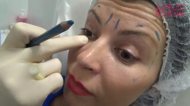 Инъекции ботулотоксинов: морщины вокруг глаз смотреть онлайн