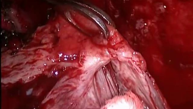 Эмпиема плевры, панцирное легкое. Торакоскопия. Thoracoscopic decortications of lung смотреть онлайн