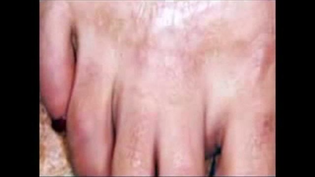 Лазерное удаление рубцов смотреть онлайн