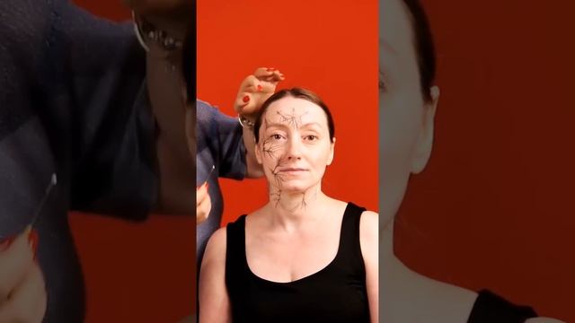 Нить Филлер. Схемы введения смотреть онлайн