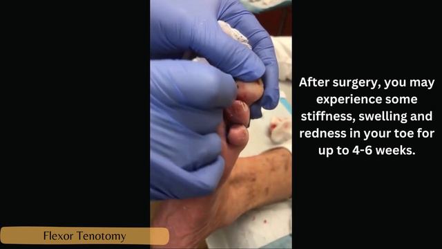 Flexor Tenotomy (Hammertoe, Mallet toe correction) смотреть онлайн