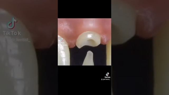 Спасение переднего зуба! смотреть онлайн