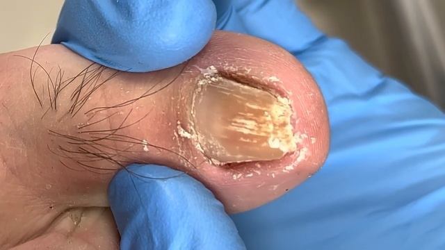 Ingrown Toenails On Both Sides To Remove Dead Skin【 Xue Yidao】