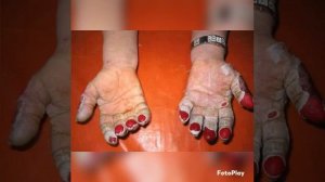 Перевал Дятлова. Обморожения. часть 2