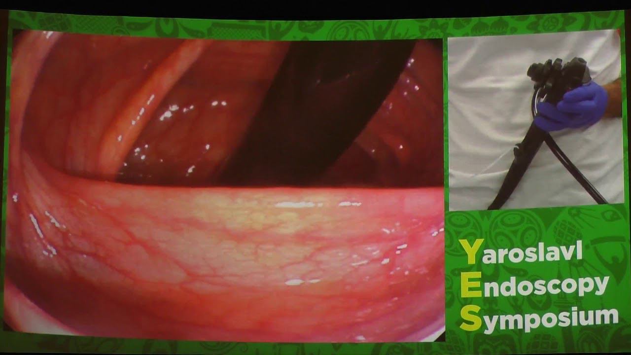 14Live Cesare Hassan Техника колоноскопии