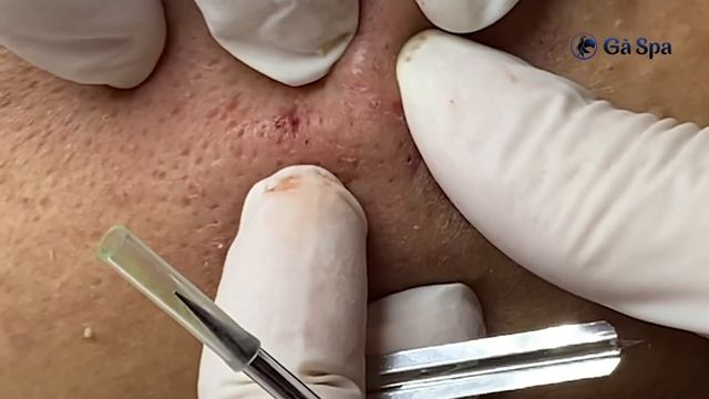 SIGNATURE SERVICE: Acnes Treatment (Ver.7) | Huge Acne смотреть онлайн