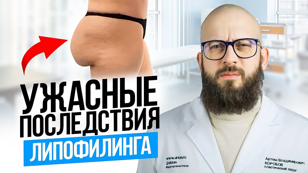 СВИСАЮЩИЕ ЯГОДИЦЫ. Последствия липофилинга. смотреть онлайн