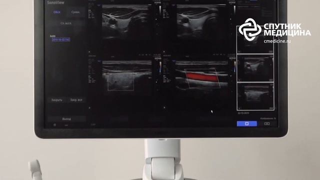 УЗИ аппарат  Samsung HS50 смотреть онлайн
