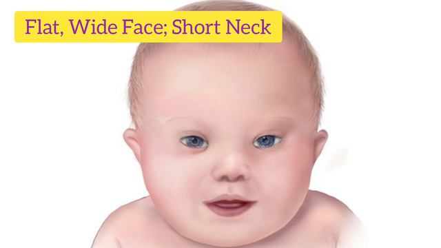 Down Syndrome (part I): Introduction, History, Symptoms | Trisomy 21 | Genetic Disorders In Humans