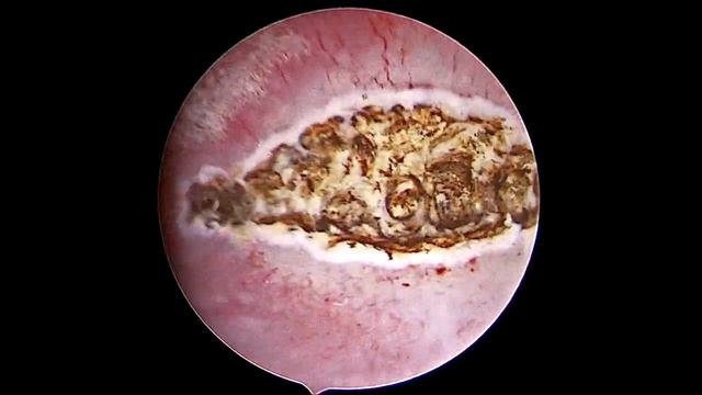 diode laser hysteroscopy for subseptum in office setting смотреть онлайн